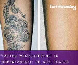 Tattoo verwijdering in Departamento de Río Cuarto