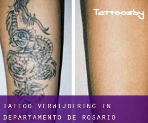 Tattoo verwijdering in Departamento de Rosario