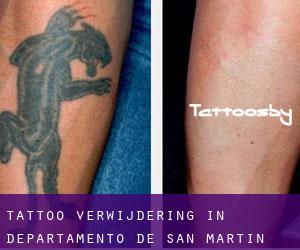 Tattoo verwijdering in Departamento de San Martín