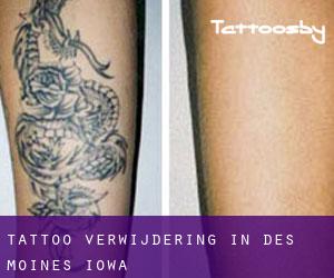 Tattoo verwijdering in Des Moines (Iowa)