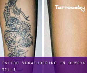 Tattoo verwijdering in Deweys Mills