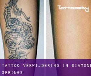 Tattoo verwijdering in Diamond Springs