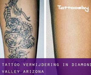 Tattoo verwijdering in Diamond Valley (Arizona)