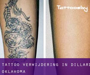 Tattoo verwijdering in Dillard (Oklahoma)