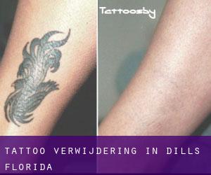 Tattoo verwijdering in Dills (Florida)