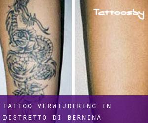 Tattoo verwijdering in Distretto di Bernina
