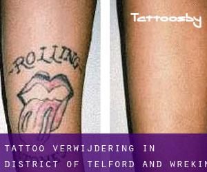Tattoo verwijdering in District of Telford and Wrekin