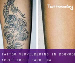Tattoo verwijdering in Dogwood Acres (North Carolina)