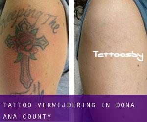 Tattoo verwijdering in Doña Ana County
