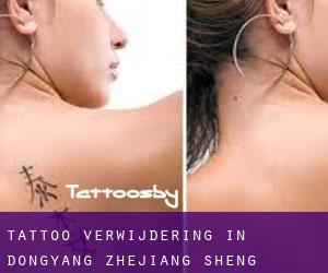 Tattoo verwijdering in Dongyang (Zhejiang Sheng)