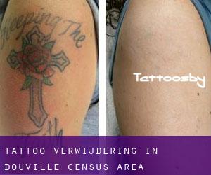 Tattoo verwijdering in Douville (census area)
