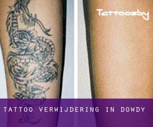 Tattoo verwijdering in Dowdy