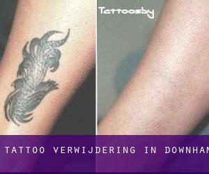 Tattoo verwijdering in Downham