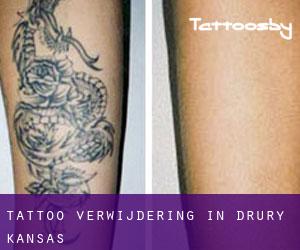 Tattoo verwijdering in Drury (Kansas)