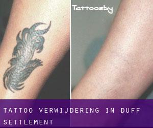 Tattoo verwijdering in Duff Settlement