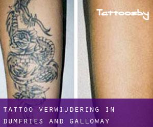 Tattoo verwijdering in Dumfries and Galloway