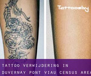 Tattoo verwijdering in Duvernay-Pont-Viau (census area)