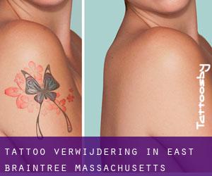 Tattoo verwijdering in East Braintree (Massachusetts)