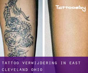 Tattoo verwijdering in East Cleveland (Ohio)