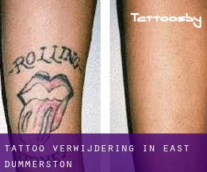 Tattoo verwijdering in East Dummerston