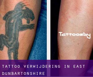 Tattoo verwijdering in East Dunbartonshire