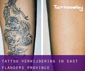 Tattoo verwijdering in East Flanders Province