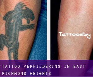 Tattoo verwijdering in East Richmond Heights