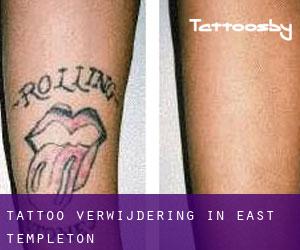 Tattoo verwijdering in East Templeton