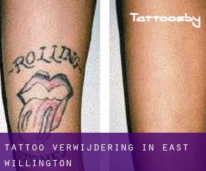 Tattoo verwijdering in East Willington
