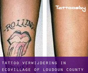 Tattoo verwijdering in EcoVillage of Loudoun County