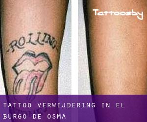 Tattoo verwijdering in El Burgo de Osma