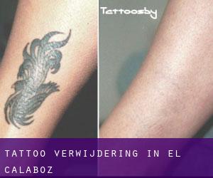 Tattoo verwijdering in El Calaboz