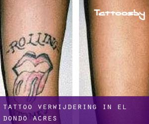 Tattoo verwijdering in El Dondo Acres
