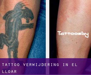 Tattoo verwijdering in el Lloar