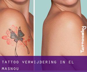 Tattoo verwijdering in el Masnou
