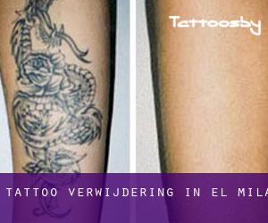 Tattoo verwijdering in el Milà