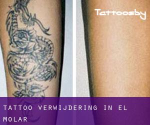 Tattoo verwijdering in El Molar