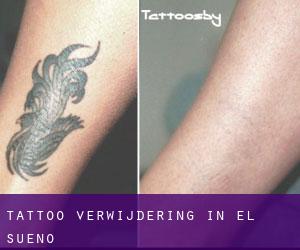 Tattoo verwijdering in El Sueno