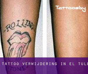 Tattoo verwijdering in El Tule