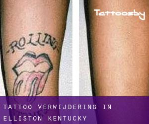 Tattoo verwijdering in Elliston (Kentucky)