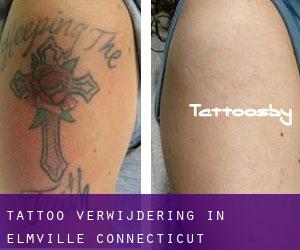Tattoo verwijdering in Elmville (Connecticut)