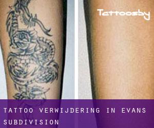 Tattoo verwijdering in Evans Subdivision