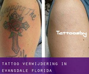Tattoo verwijdering in Evansdale (Florida)