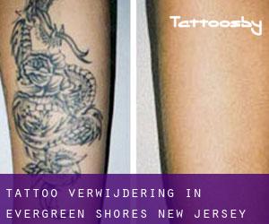 Tattoo verwijdering in Evergreen Shores (New Jersey)