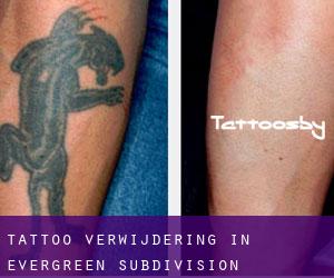 Tattoo verwijdering in Evergreen Subdivision