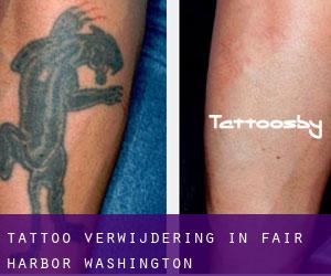 Tattoo verwijdering in Fair Harbor (Washington)