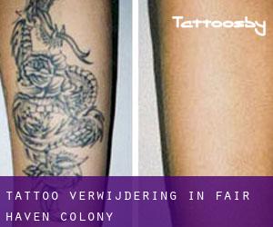 Tattoo verwijdering in Fair Haven Colony