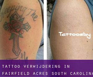 Tattoo verwijdering in Fairfield Acres (South Carolina)
