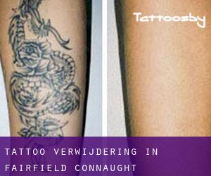 Tattoo verwijdering in Fairfield (Connaught)