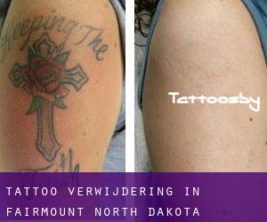 Tattoo verwijdering in Fairmount (North Dakota)